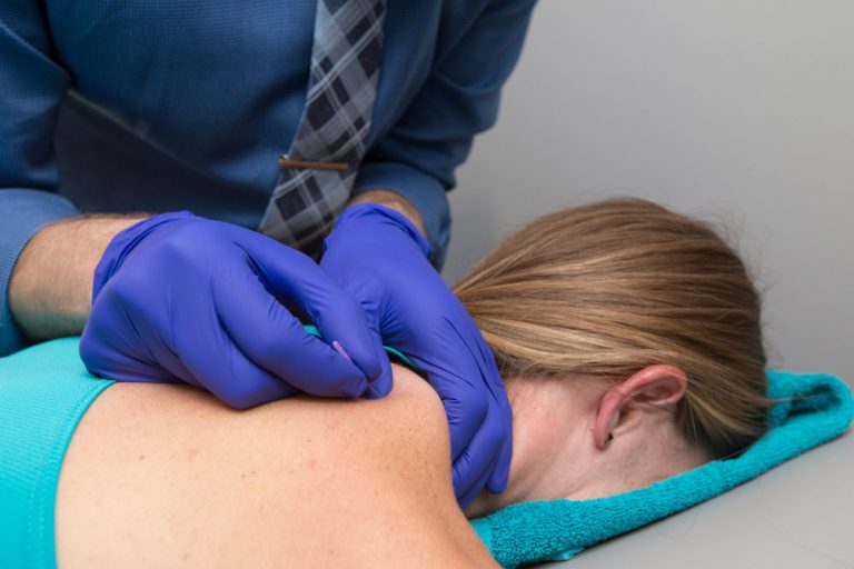 Dry Needling