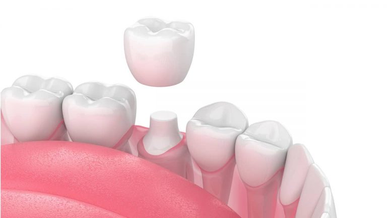Things One Must Know About Dental Crown