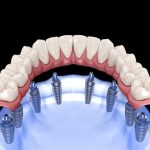 How Dental Implants Enable You to Enjoy Temperature-Sensitive Foods Without Discomfort