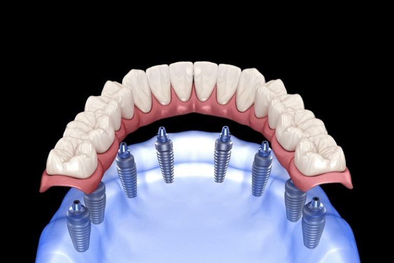 How Dental Implants Enable You to Enjoy Temperature-Sensitive Foods Without Discomfort