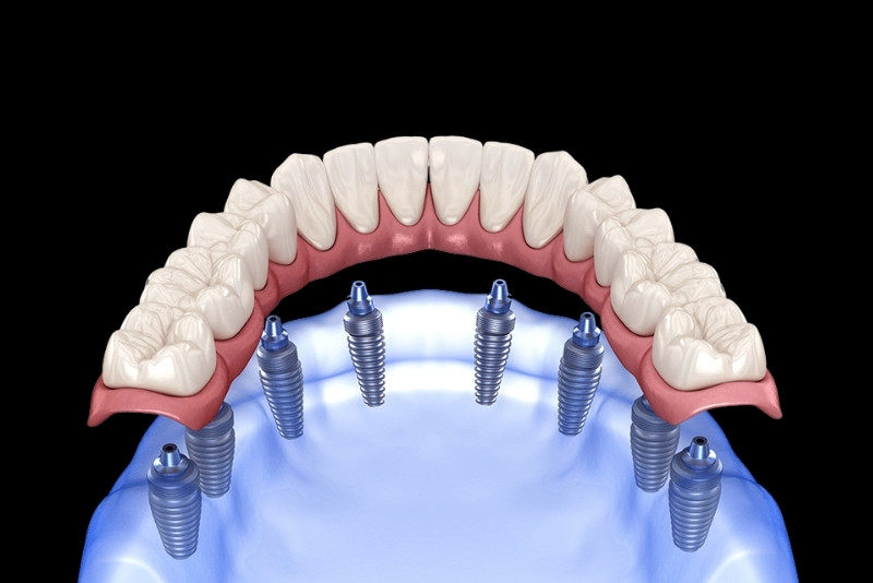 How Dental Implants Enable You to Enjoy Temperature-Sensitive Foods Without Discomfort